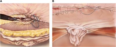 Robotic Surgical Procedures for Ventral Hernia Repair